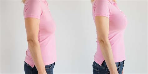 3 Steps of the Vampire Breast Lift Procedure. . Vampire breast lift photos